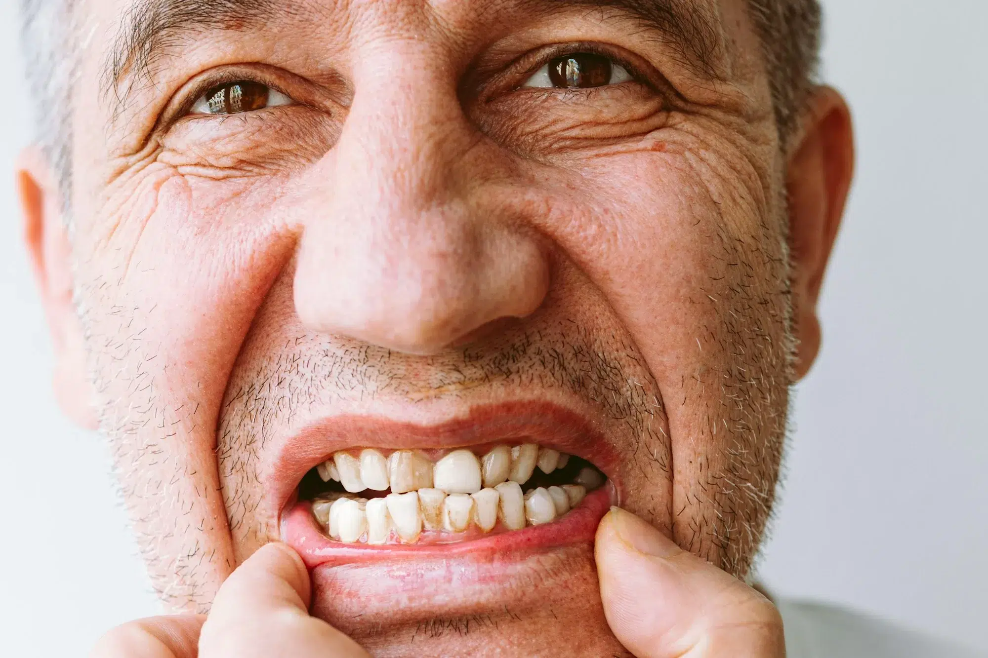 Close-up portrait of man showing teeth with tartar on white background