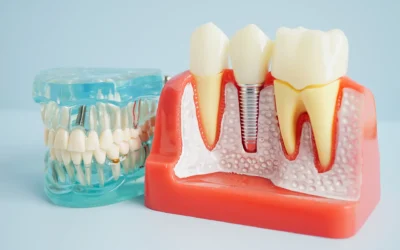Carico Immediato negli Impianti Dentali a Cagliari: Vantaggi e Considerazioni
